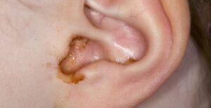 Ear Leaking Clear Fluid No Pain Learn the Common Causes