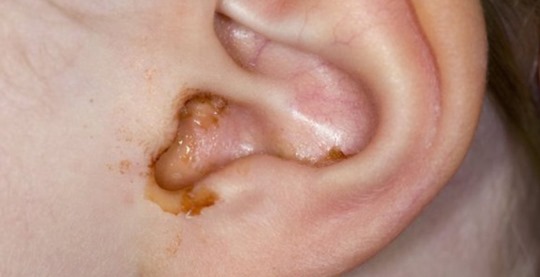 ear leaking clear fluid no pain