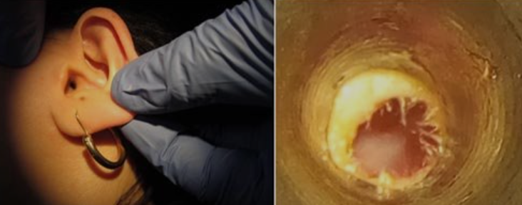 fungal ear infection