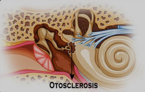 What is Otosclerosis