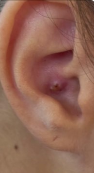 pimple on earlobe