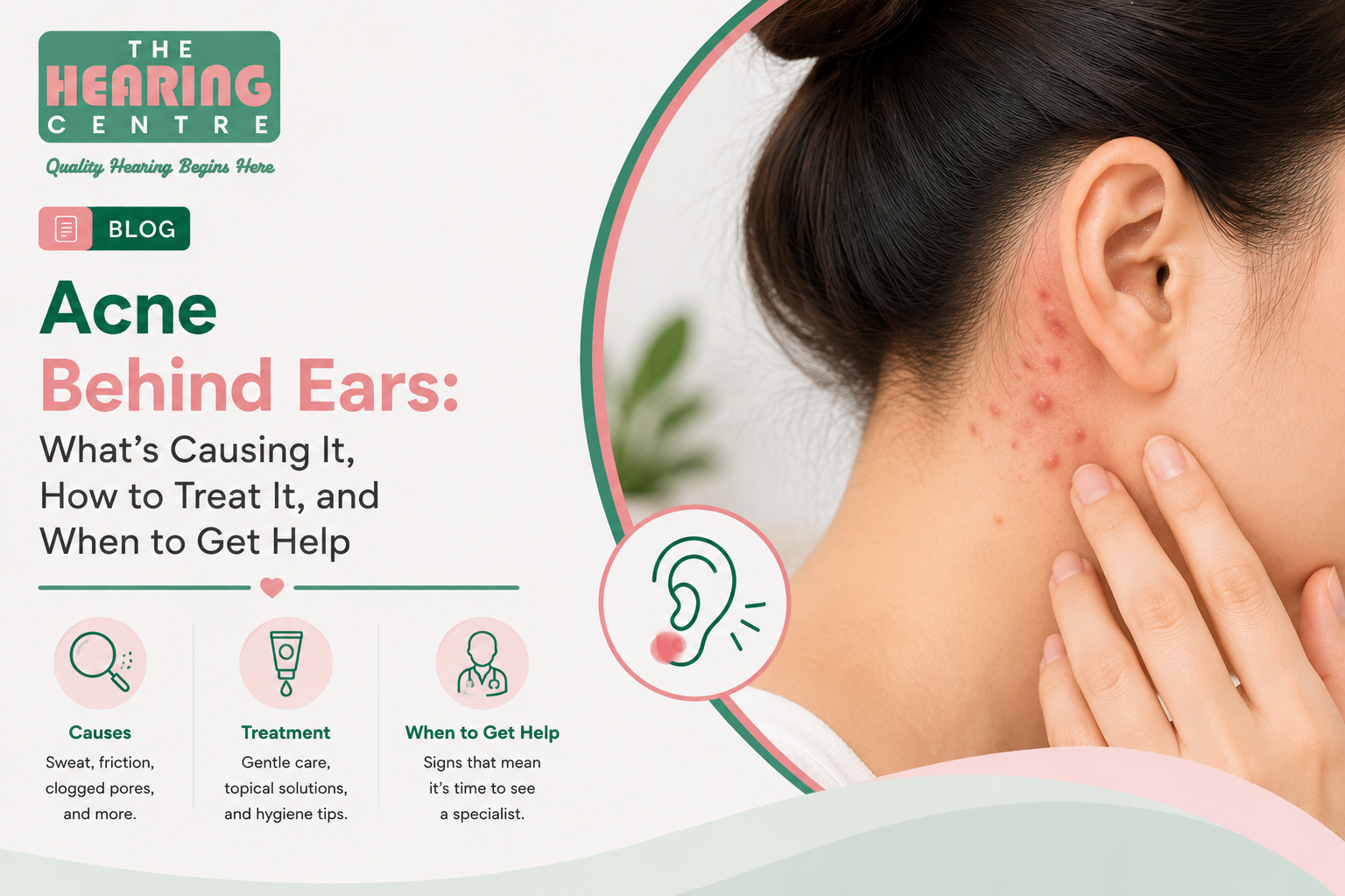 Acne Behind Ears